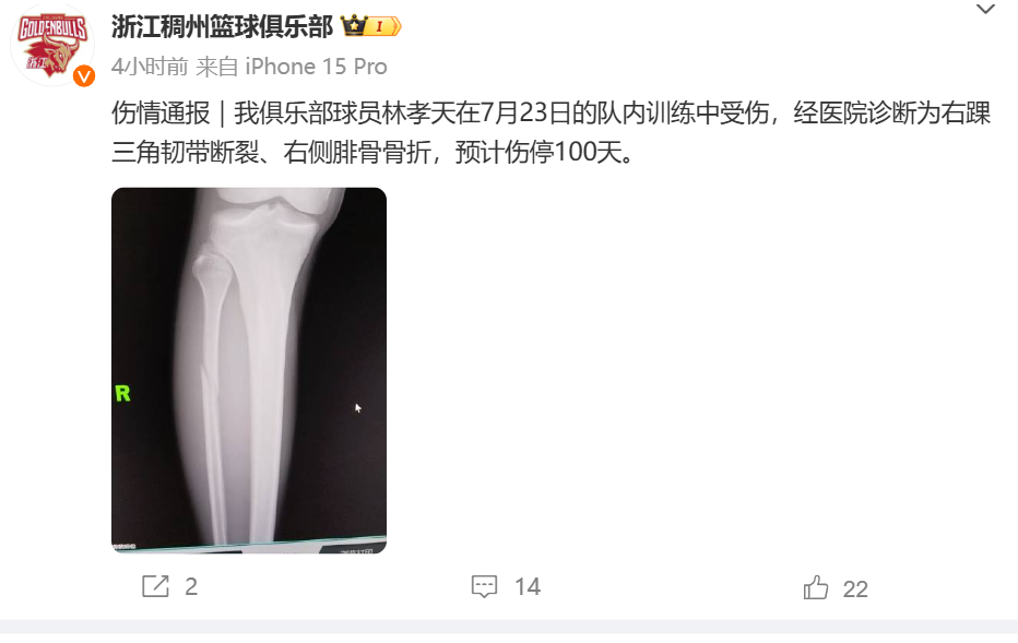 🤕官方浙江男篮：林啸天右脚踝三角韧带断裂 右腓骨骨折 预计他将缺席100天